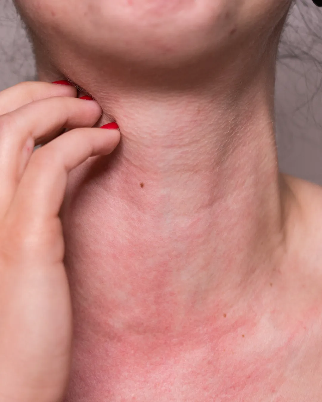 A close view of raised, reddened hives across a person's neck and chest