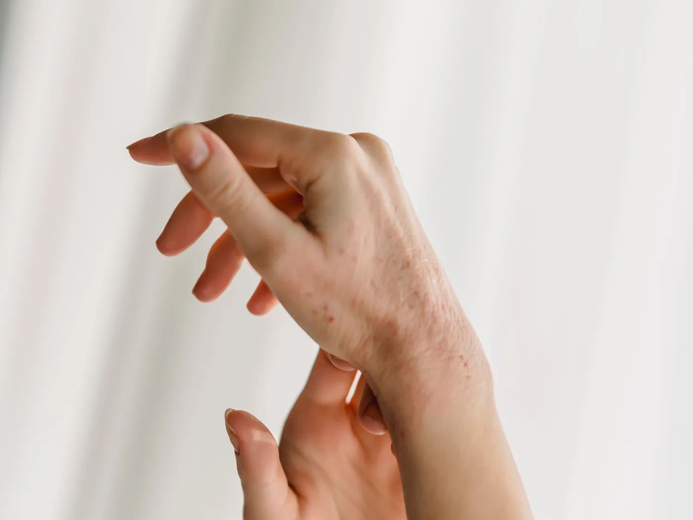 A close view of irritated, reddened skin on a person's hand and wrist