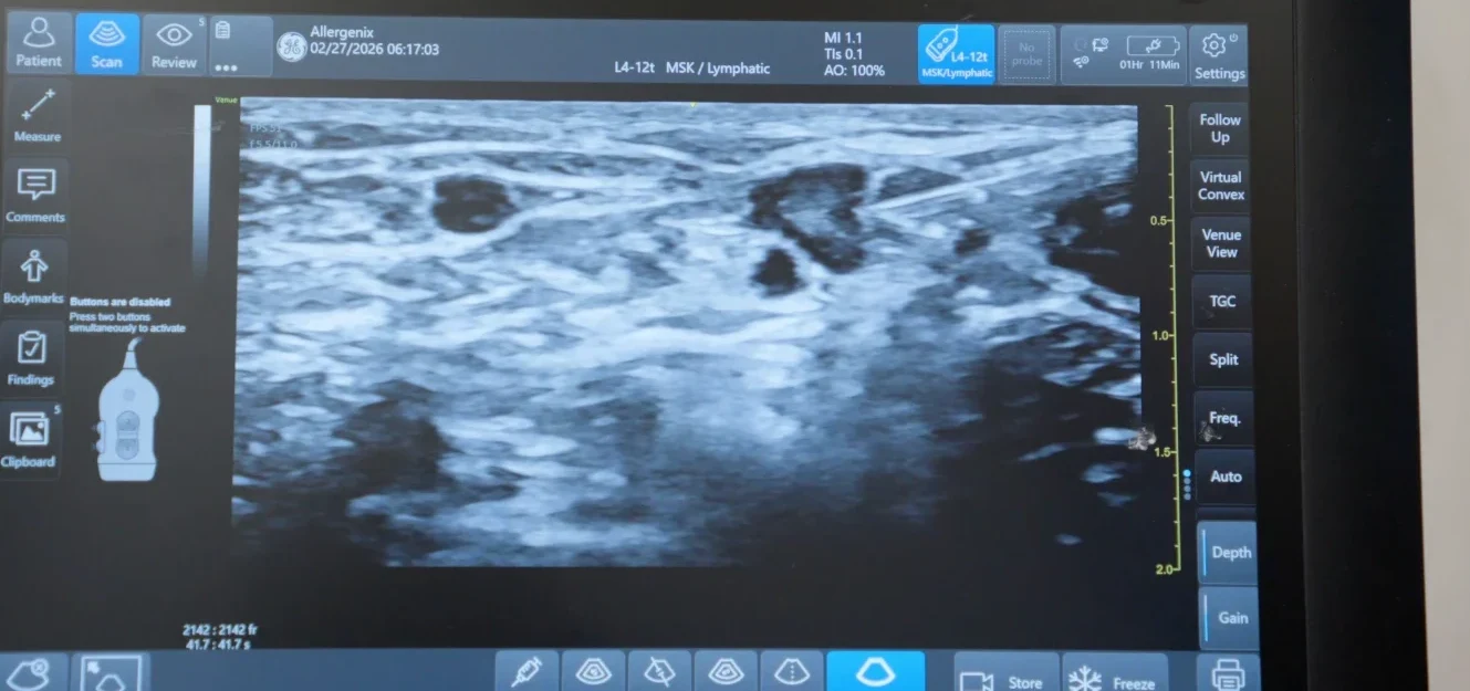 An ultrasound screen mid-scan, showing a lymph node during a RapImmune injection, on a GE machine in the clinic